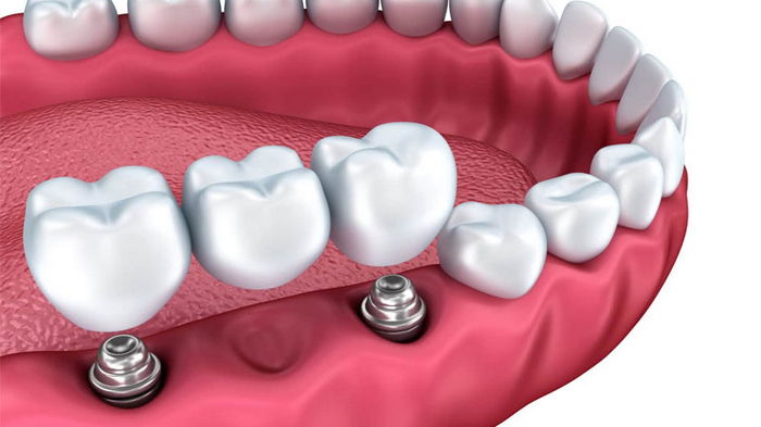 Какие варианты восстановления жевательных зубов возможны: плюсы и минусы каждого решения