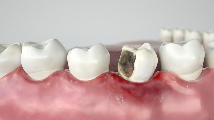 Особенности развития, проявления и лечения кариеса между зубами. Действенные меры профилактики
