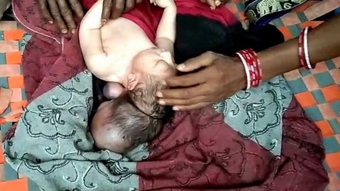 В Индии родился трехглавый младенец