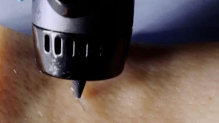 Заживляющие тату: ученые создали ручку с чернилами, способными быстро и легко заживлять раны