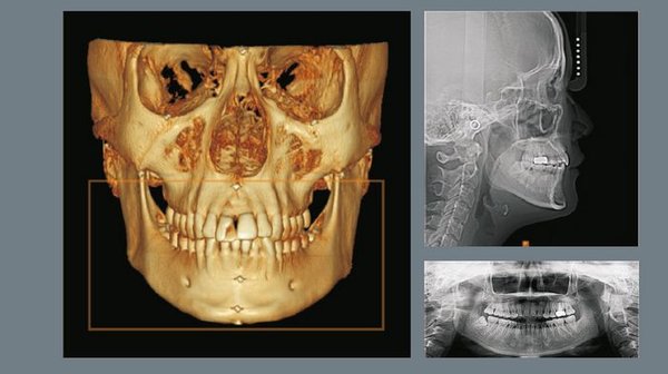 Особенности применения компьютерной томографии в стоматологии