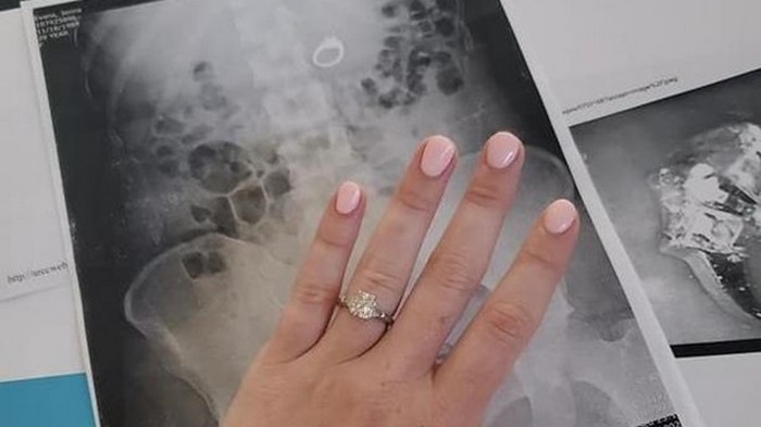 Девушка съела кольцо, пряча его от воров из сна (фото)